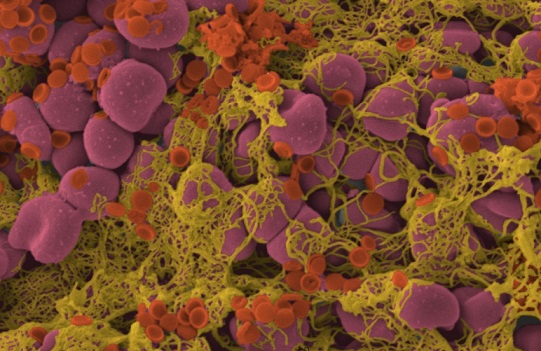 ictus,-150mila-nuovi-casi-all’anno-in-italia-dalla-nanomedicina-un-farmaco-intelligente-che-scioglie-il-coagulo-–-insalutenews.it